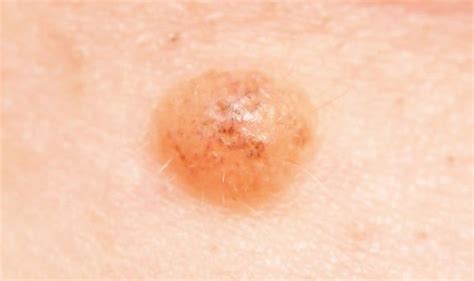 Skin Cancer Does Your Mole Look Like This Pictures Reveal Cancer Risk