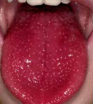 Here we have listed the possible causes of a black tongue and how to get rid of this condition naturally. Red Spots on Tongue, Small, Dots, Tip, Back, Back, How to ...