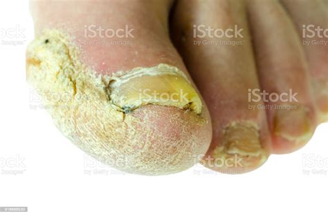 Extreme Bad Foot Skin Bacterial Fungal Infection With Damaged Nail