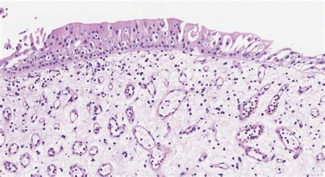 Polypoid Cystitis Atlas Of Pathology