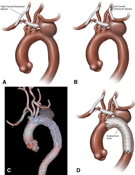 Novel Approaches For The Treatment Of The Aberrant Right Subclavian