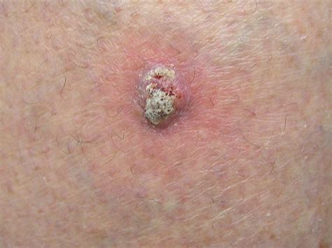 Maybe you would like to learn more about one of these? Symptoms of Merkel Cell Carcinoma | Merkel Cell Carcinoma