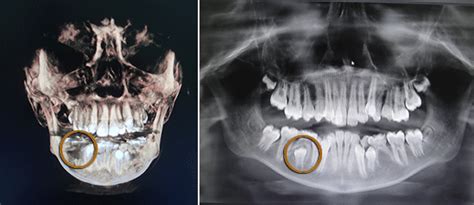 Dentigerous Cyst Treatment Cured By Trephine Technique
