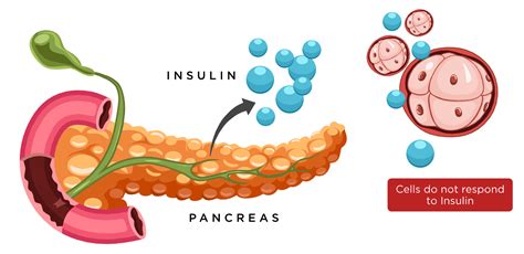 Insulin Which Is Produced By The Pancreas Is Used To