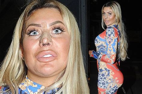Chloe Ferry Before Surgery And After Page 4 Of 4 Clarek