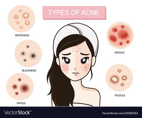 Girl Type Acne Vector Image On Vectorstock Acne Types Of Acne