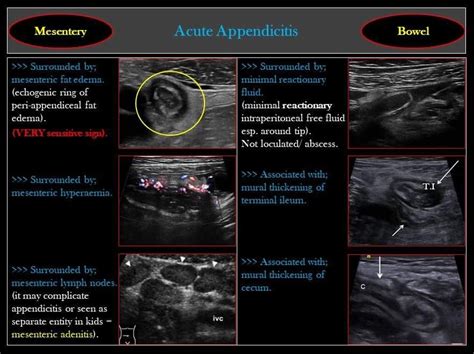 Acute Appendicitis Usg Medical Ultrasound Obstetric Ultrasound