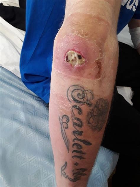 A female black widow spider. Gruesome pictures after 'false widow' spider bite left man with oozing hole in elbow and needing ...