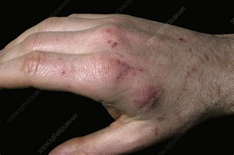 Cat Scratch Disease Stock Image C051 5374 Science Photo Library