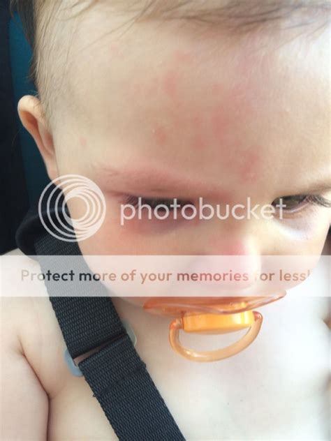 Hayfever Rash On Face Pics Included Babycentre