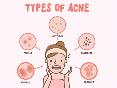 What Are The Different Types Of Acne And How To Treat Them Skinkraft