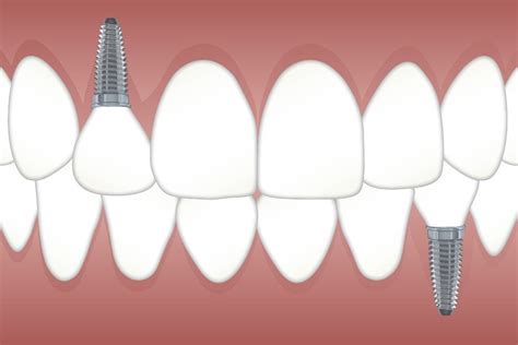 solstice oral and vision health blog advantages of dental implants