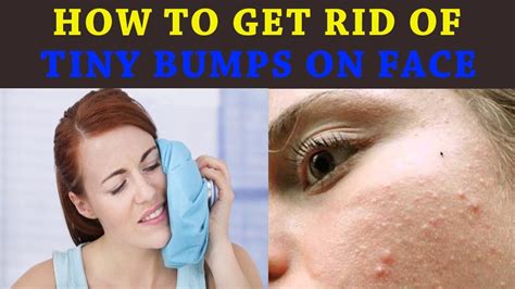 How To Get Rid Of Tiny Bumps On Face How To Get Rid Of Pimples In 5 Minutes With Home Remedies