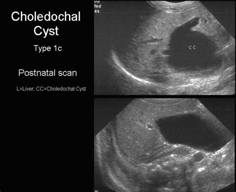 Ultrasound Classification Of Choledochal Cyst My XXX Hot Girl