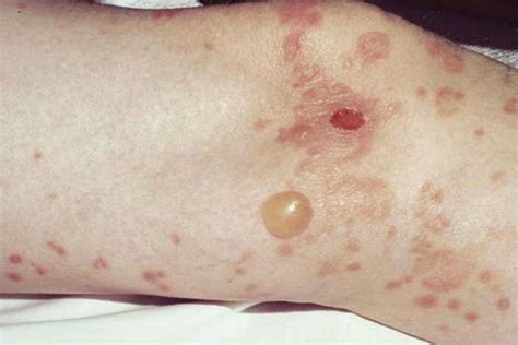 Blood Blisters On Groin Area Female Boils Pictures On Skin Causes And