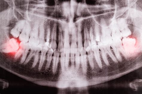 Impacted Wisdom Teeth On An Xray Picture With An Inflamed Cyst Neoplasm