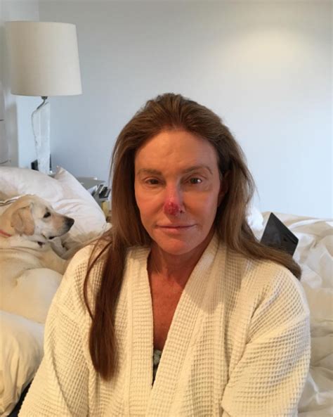 See Caitlyn Jenners Photo After Having Skin Cancer Cut From Her Nose