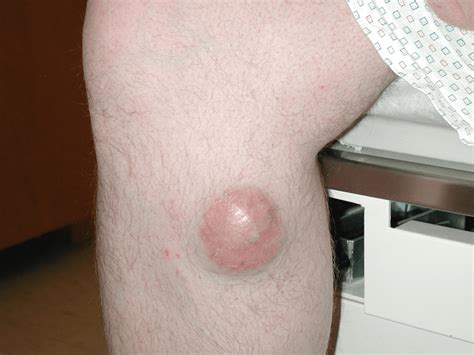 According to the skin cancer foundation, merkel cell cancers kill about one in three patients while signs of skin cancer, including melanoma, are relatively easy to recognize, merkel cell cancers are. Clinical Photos of Merkel Cell Carcinoma | Merkel Cell ...