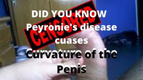 Peyronies Disease Also Called Penile Fibrosis Or Curved Penis Youtube