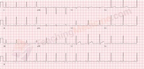 Ecg Demonstrating Normal Sinus Rhythm Normal Axis Non Specific Images And Photos Finder