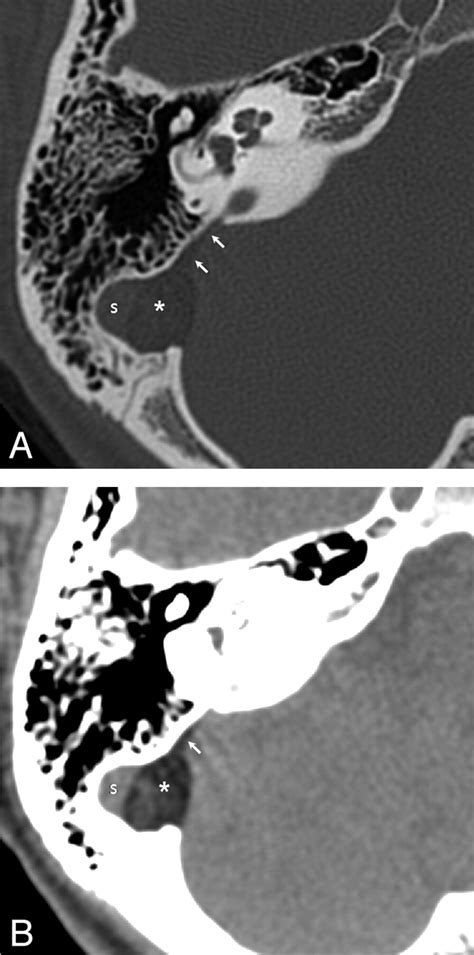 Intracranial Dermoid Cyst Ruptured Into The Membranous Labyrinth