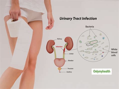 What Is Urinary Tract Infection UTI Here Are Its Causes Symptoms Treatment And Preventive