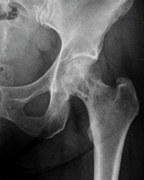 Read on for information on the symptoms, causes, and conventional treatment of dog bone cancer. Secondary Bone Cancer In The Hip Photograph by Zephyr ...