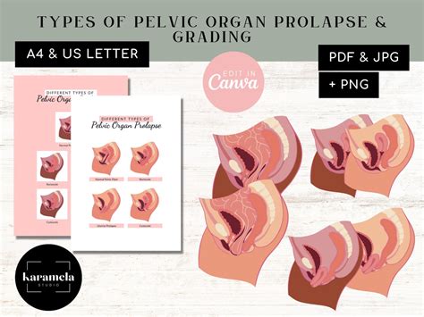 Types Of Pelvic Organ Prolapse Rectocele Stages Cystocele Etsy Uk