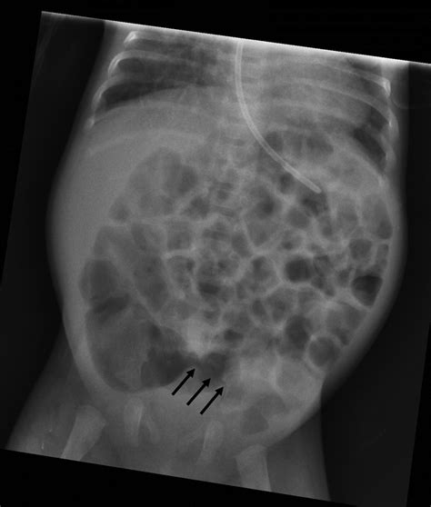 A Gas Filled Appendix On A Plain X Ray Of The Abdomen In A Preterm