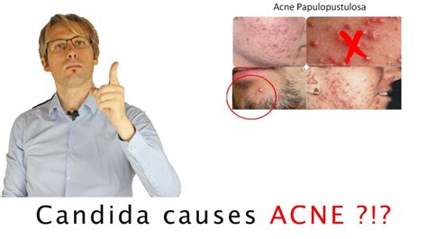 Candida Acne Lets Smash Together This Bs Youtube