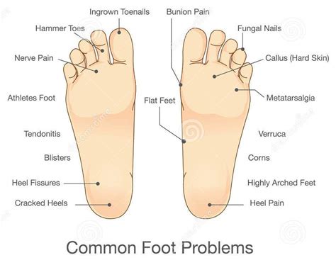 Common Foot Problems Almawi Limited The Holistic Clinic
