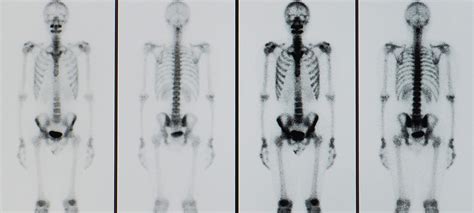 Scintigraphy Allows Doctors To See Changes And Abnormalities Inside
