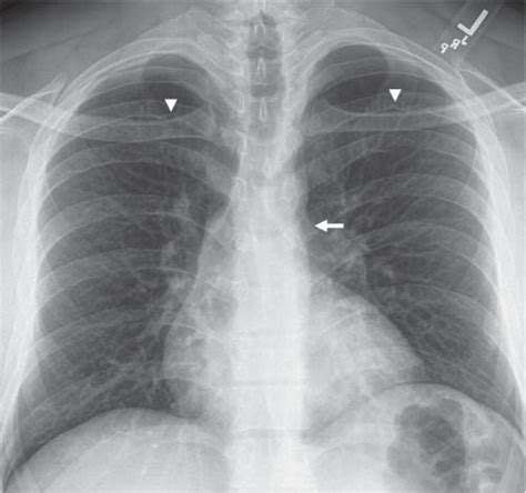 Chest Wall The Ribs Radiology Key