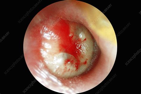 Ear Infection Otoscope View Stock Image C0261040 Science Photo