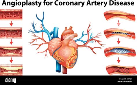 Diagrama Que Muestra La Enfermedad De La Arteria Coronaria Angioplastia