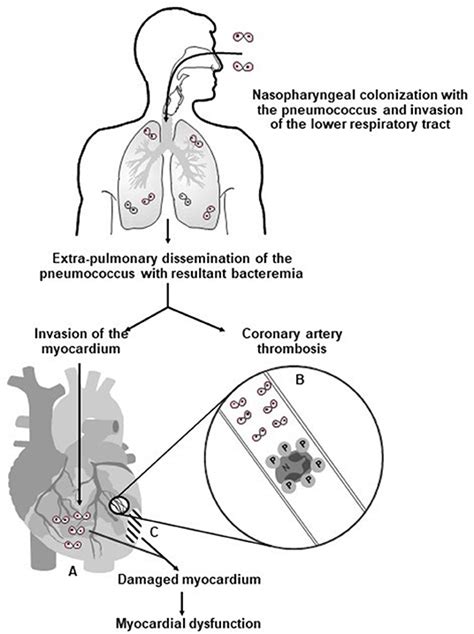 Ventilator Associated Pneumonia Pathophysiology