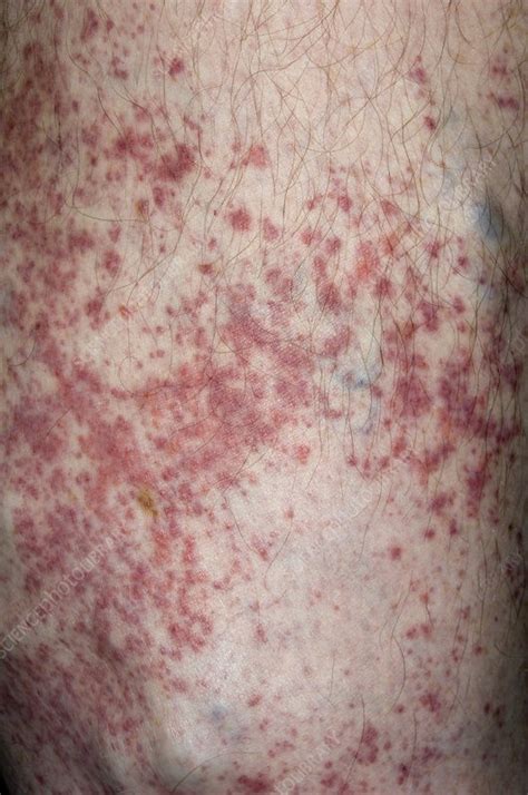 Allergic Skin Reaction To Diathermy Pad Stock Image C0029562