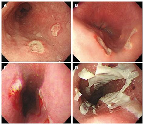Clinical And Endoscopic Characteristics Of Drug Induced Esophagitis