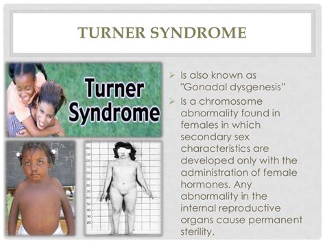 Pervasive Developmental Disorders Turner Syndrome Klinefelters Syn