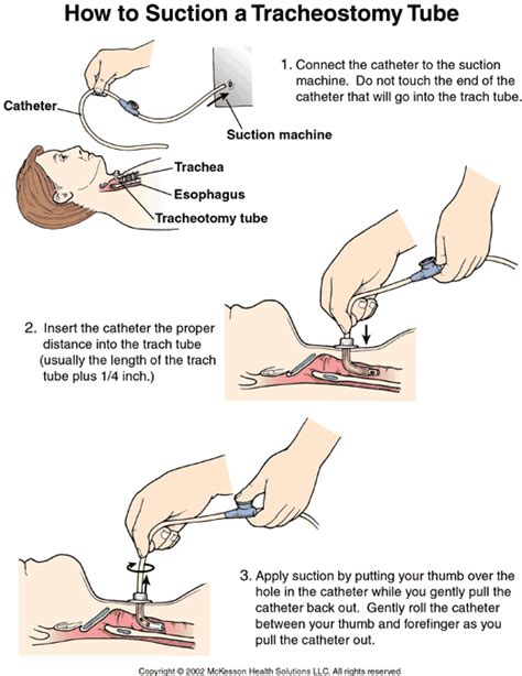 How To Suction A Tracheostomy Tube Illustration Nursing Care