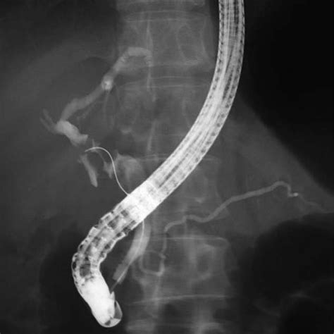 Endoscopic Retrograde Cholangiopancreatography Ercp Findings At The