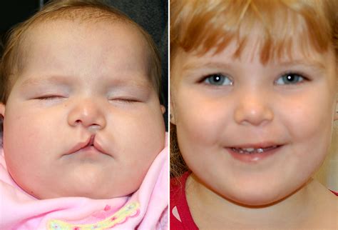 Oral surgeon in melbourne, florida who performs cleft lip surgery. Dr. Moses - New Orleans - Cleft Lip Repair Pictures