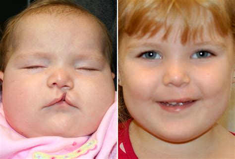 Maybe you would like to learn more about one of these? Dr. Moses - New Orleans - Cleft Lip Repair Pictures