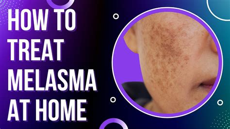 Understanding Melasma Treatments