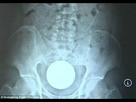 Chinese Man Has A In Wide Glass Ball Stuck In His Rectum After Inserting Into His Body