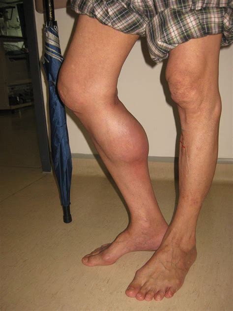 Ruptured Baker’s cyst | The BMJ