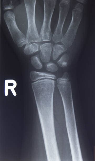 Carpal Bones X Ray Anatomy