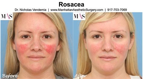 Ipl Face Treatment Before After Doctor Heck