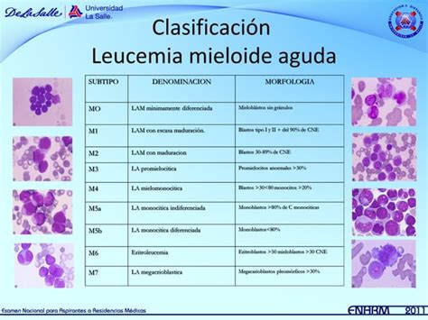 Leucemias Agudas Pediatr A