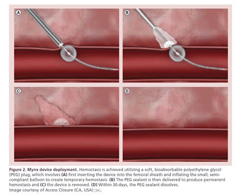 Mynx Interventional Cardiology Cardiac Catheterization Percutaneous